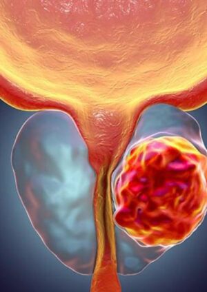cura de cáncer de próstata